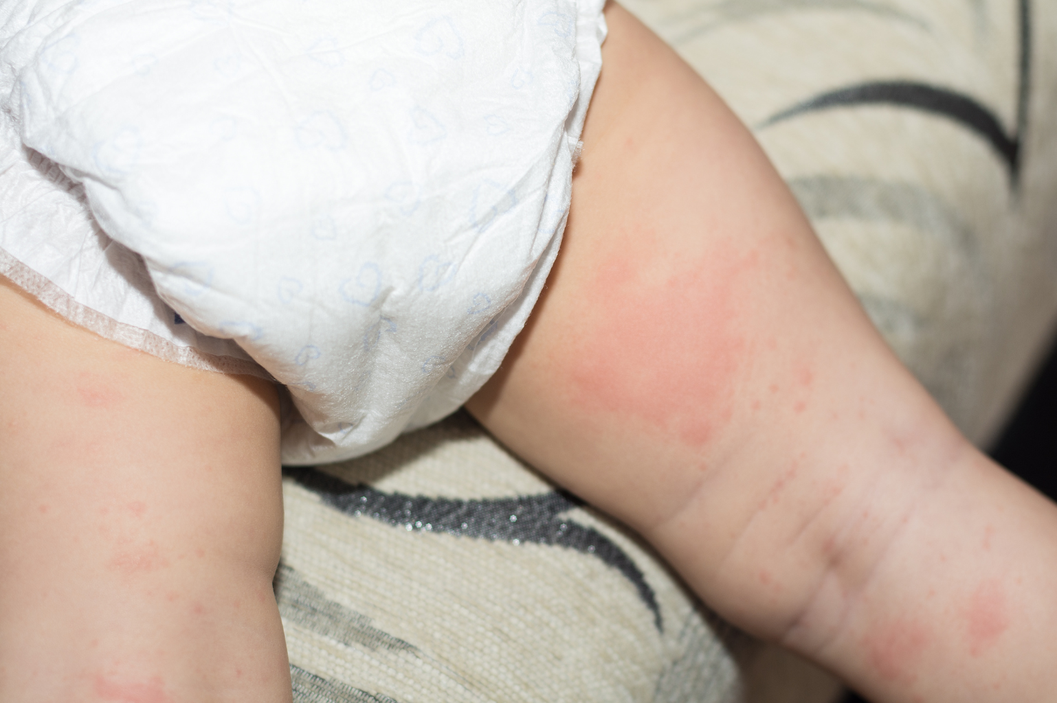 Eczema vs Diaper Rash