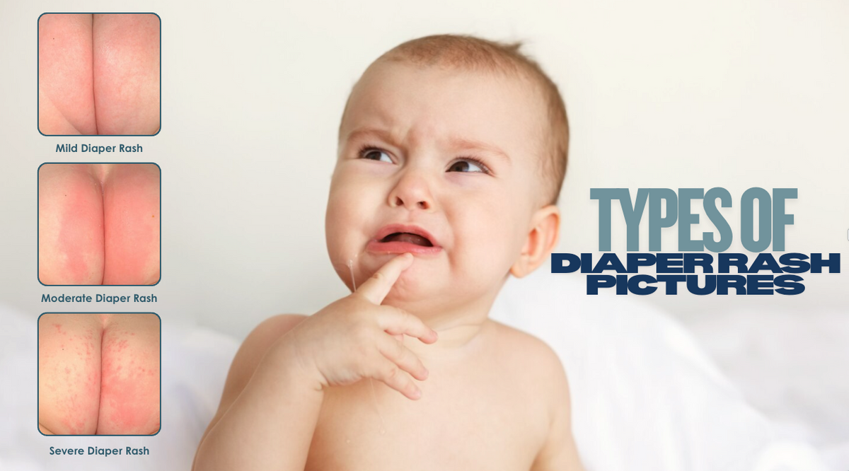 Types Of Diaper Rash Pictures And How To Identify Them