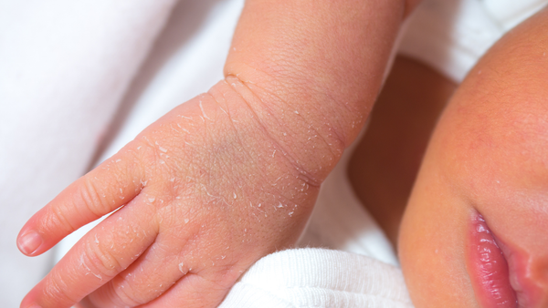 Newborn Skin Peeling: Causes, Care, and When to Worry